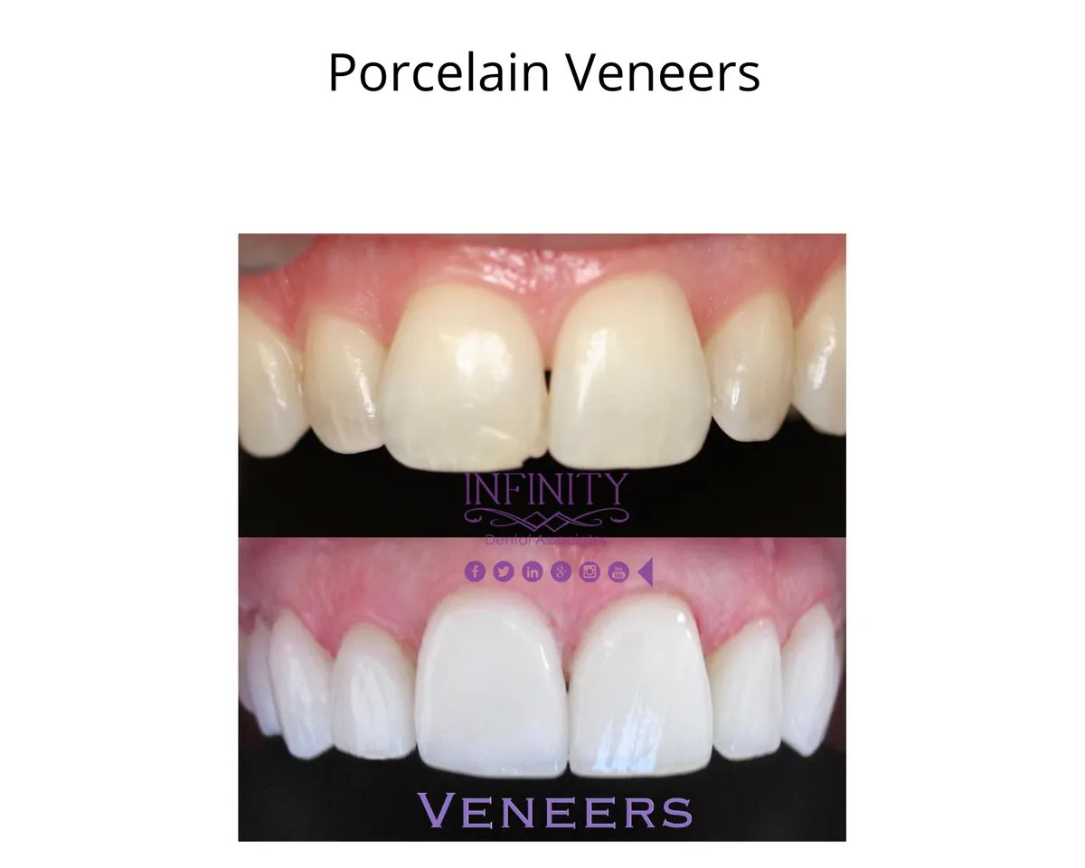 32531 whitening veneers procedure