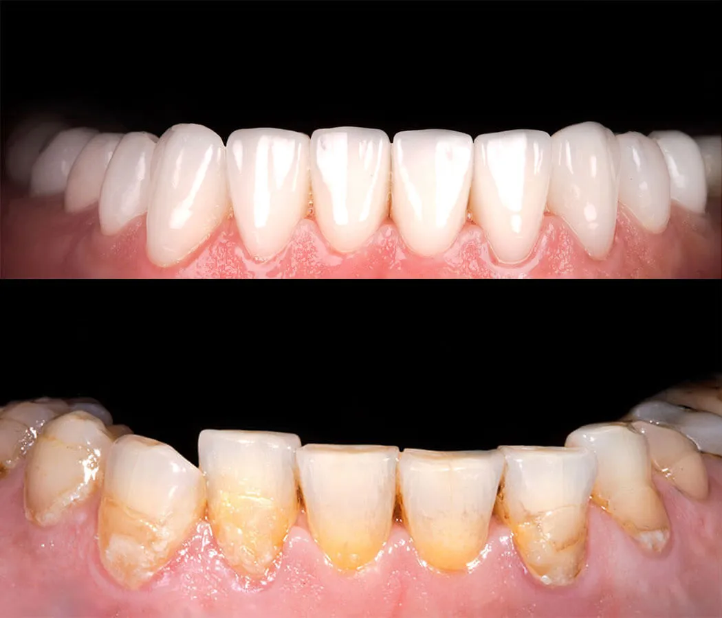 32531 whitening veneers smile