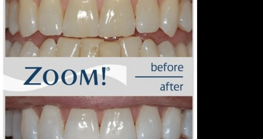 32535 teeth whitening auckland nz clinic