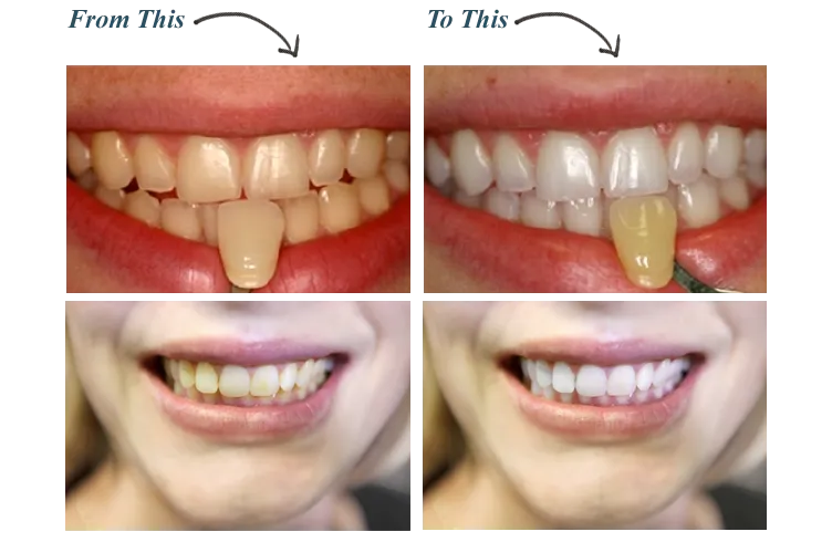 32538 at home whitening kit