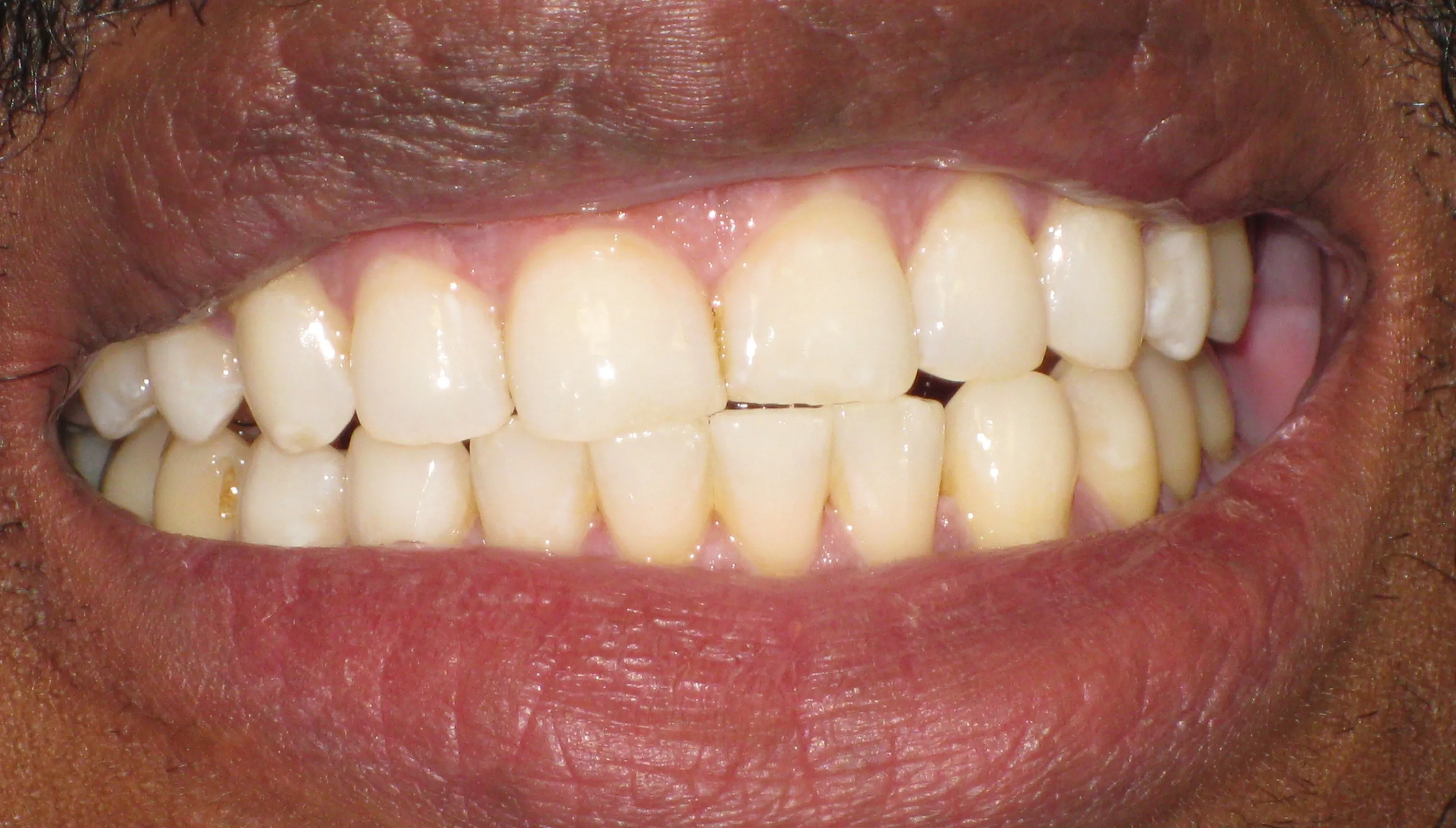 32539 private teeth whitening