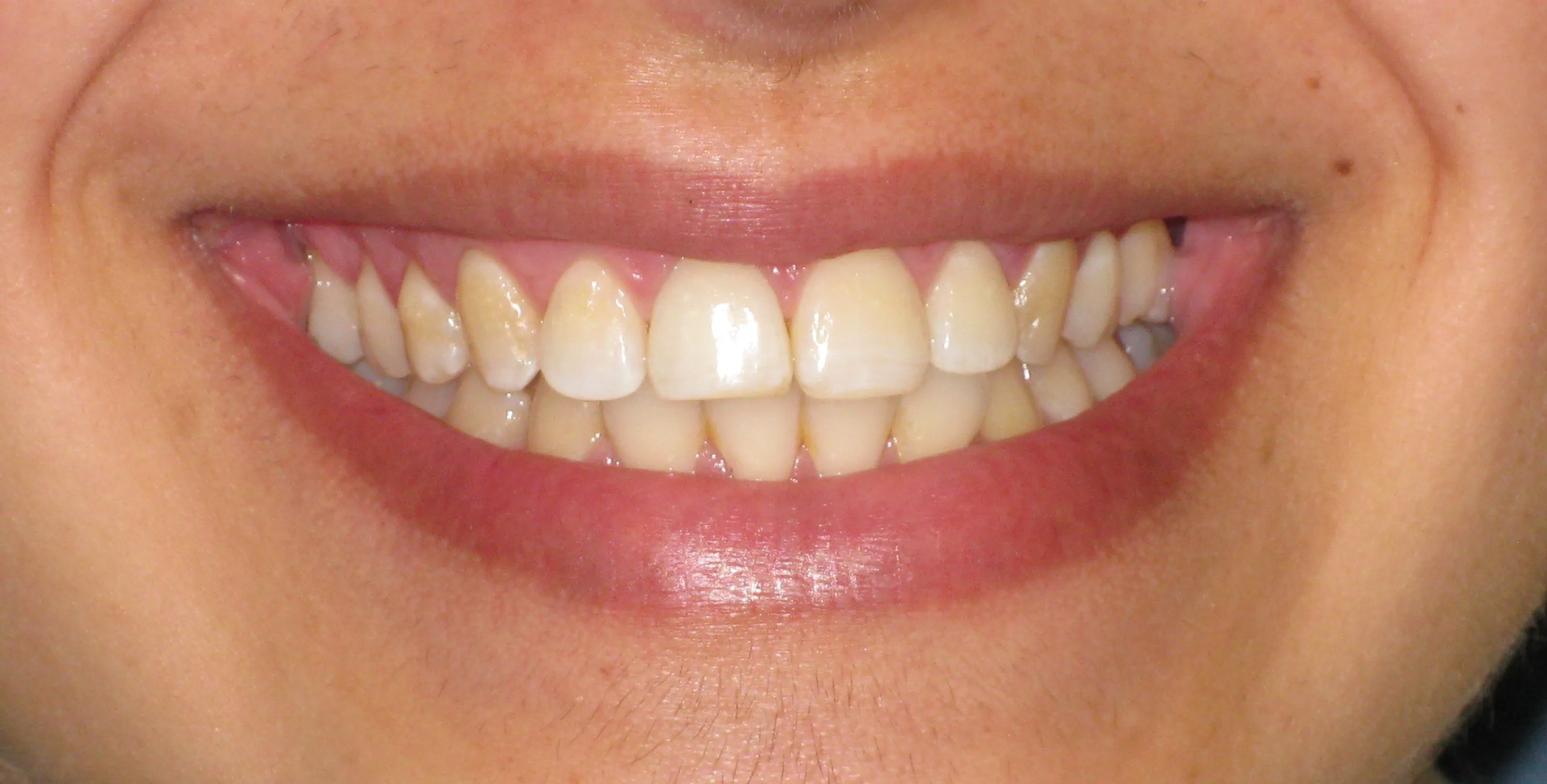 32539 teeth whitening options