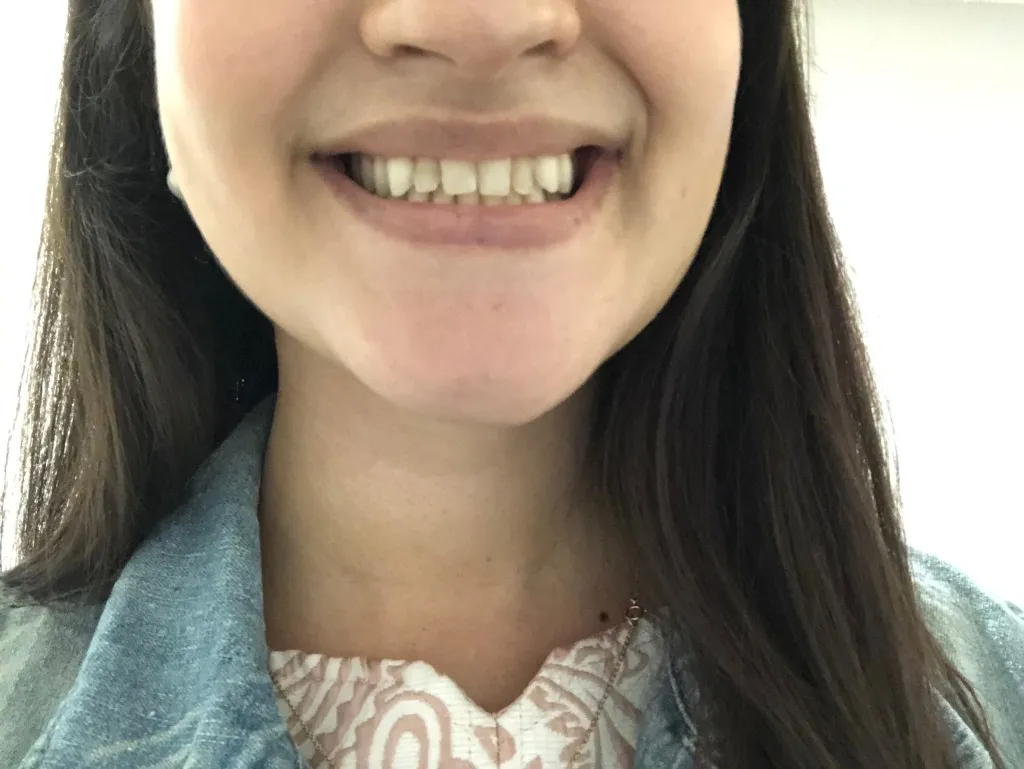 32544 sensitive teeth whitening 1