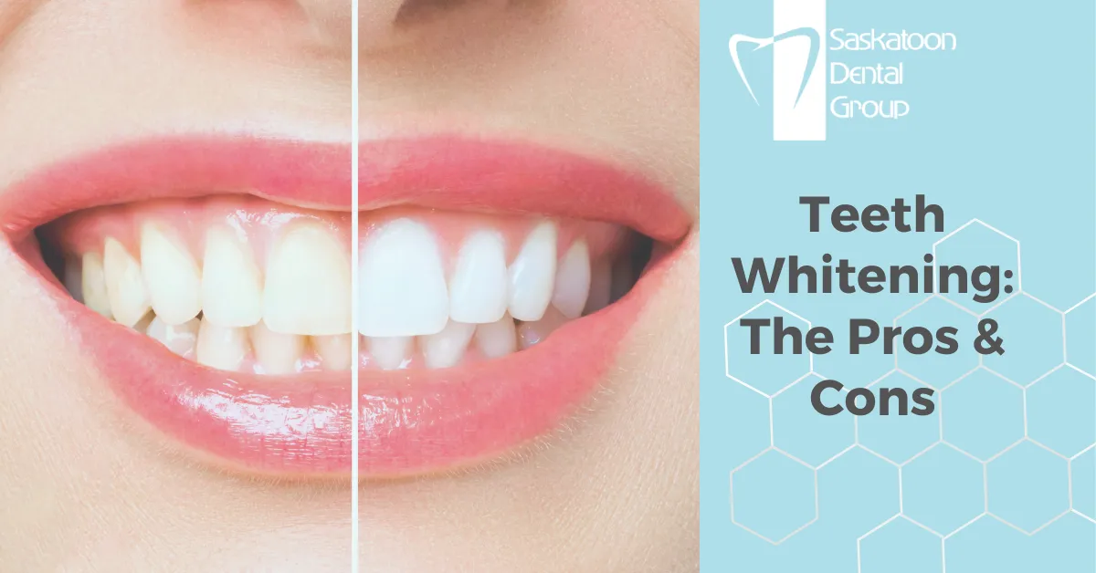 /img/32561-alternatives-to-whitening.webp