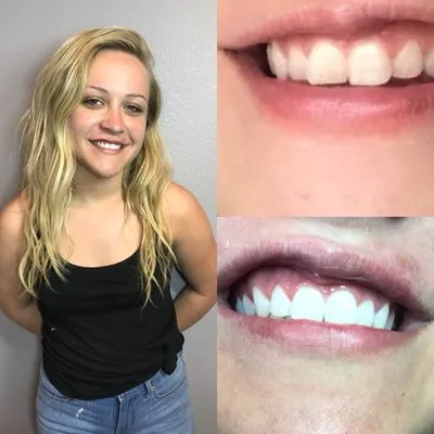 32577 at home teeth whitening
