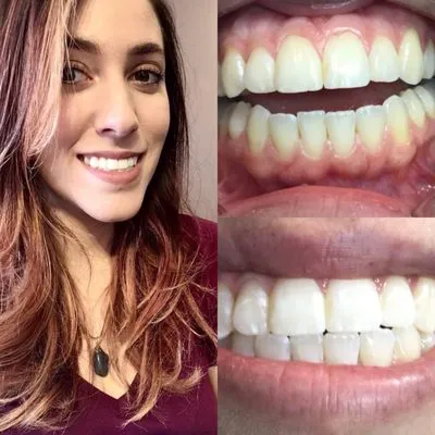 32577 in office teeth whitening