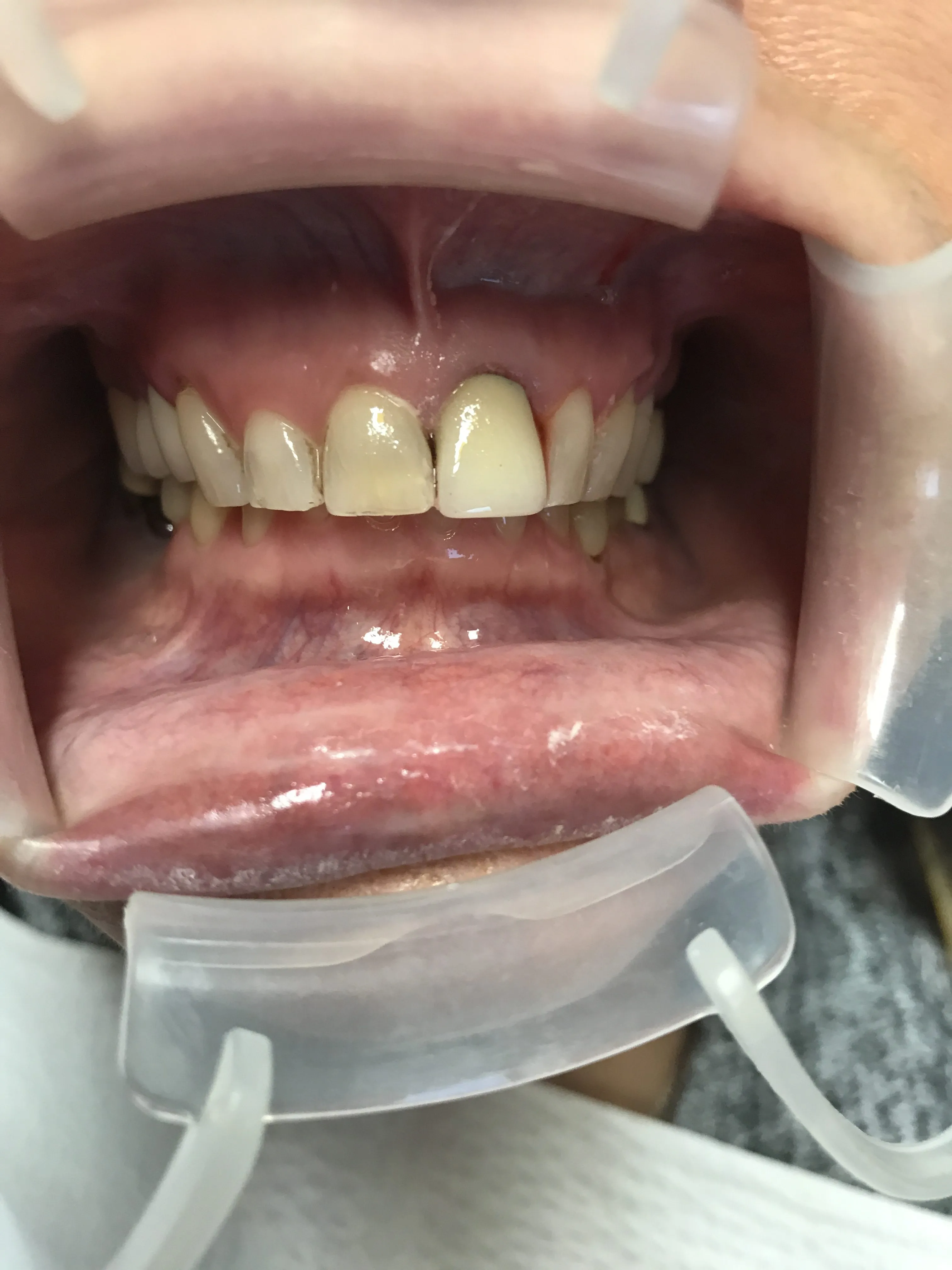 32590 foods that stain teeth