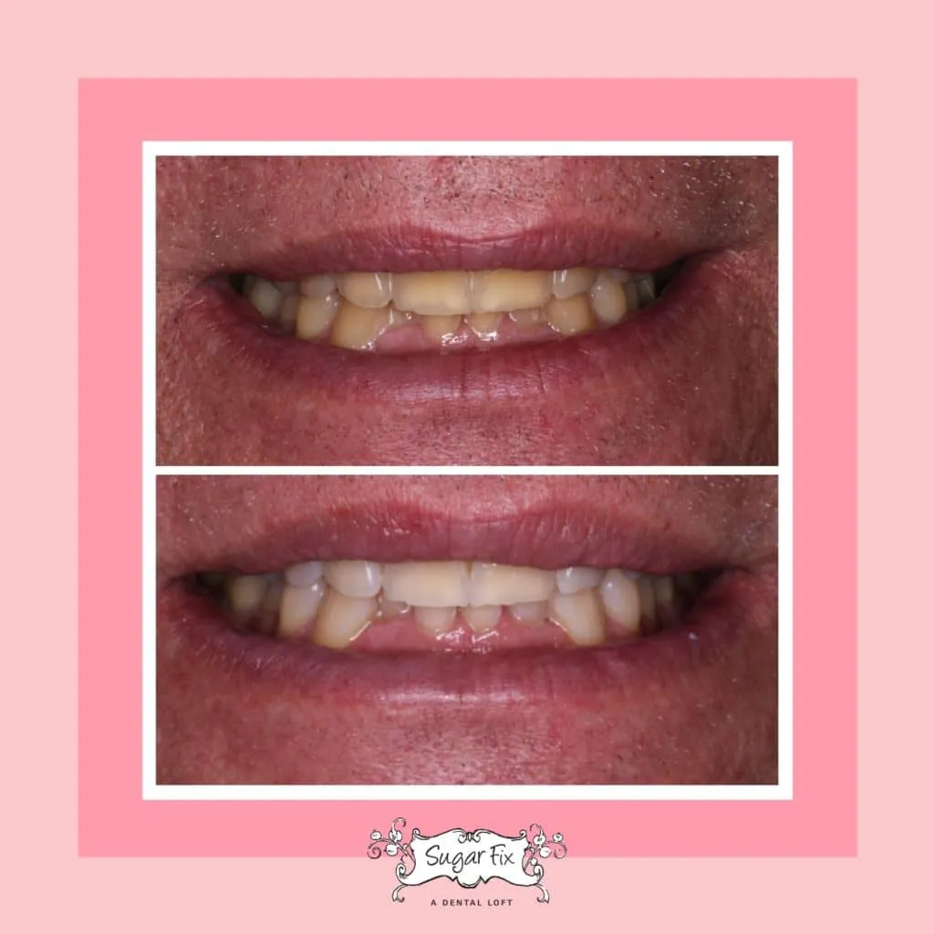 32590 proper brushing technique