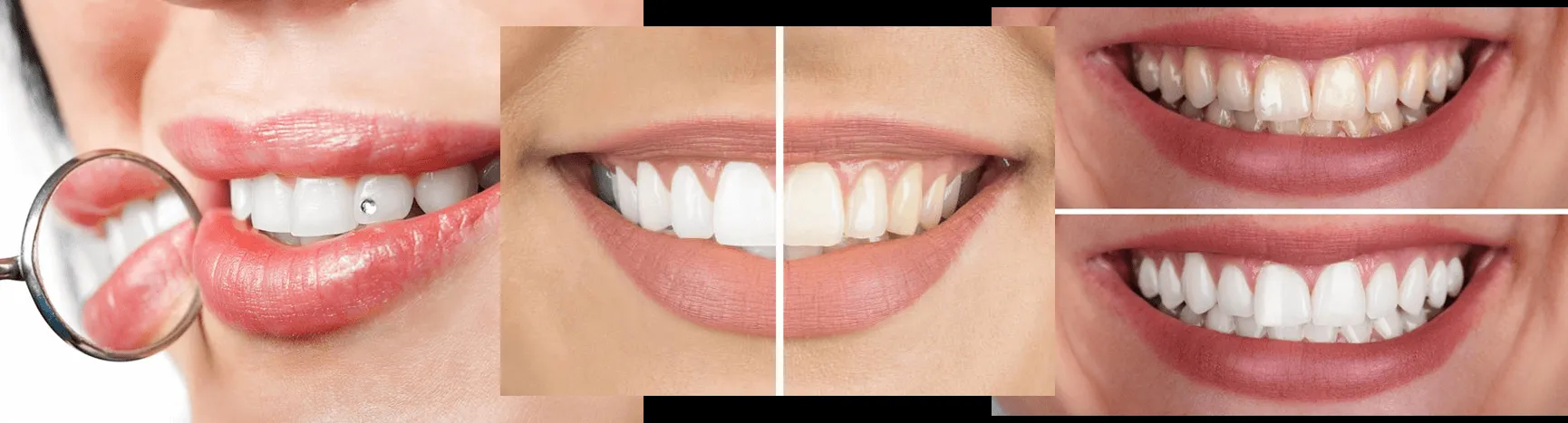 32590 sugarland teeth whitening consultation