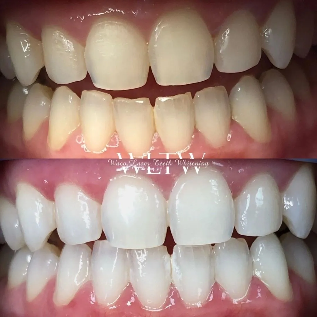 32593 teeth whitening waco image 1