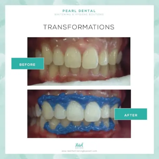 32594 teeth whitening aftercare