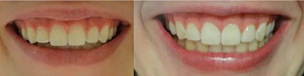 32595 charcoal teeth whitening risks image3