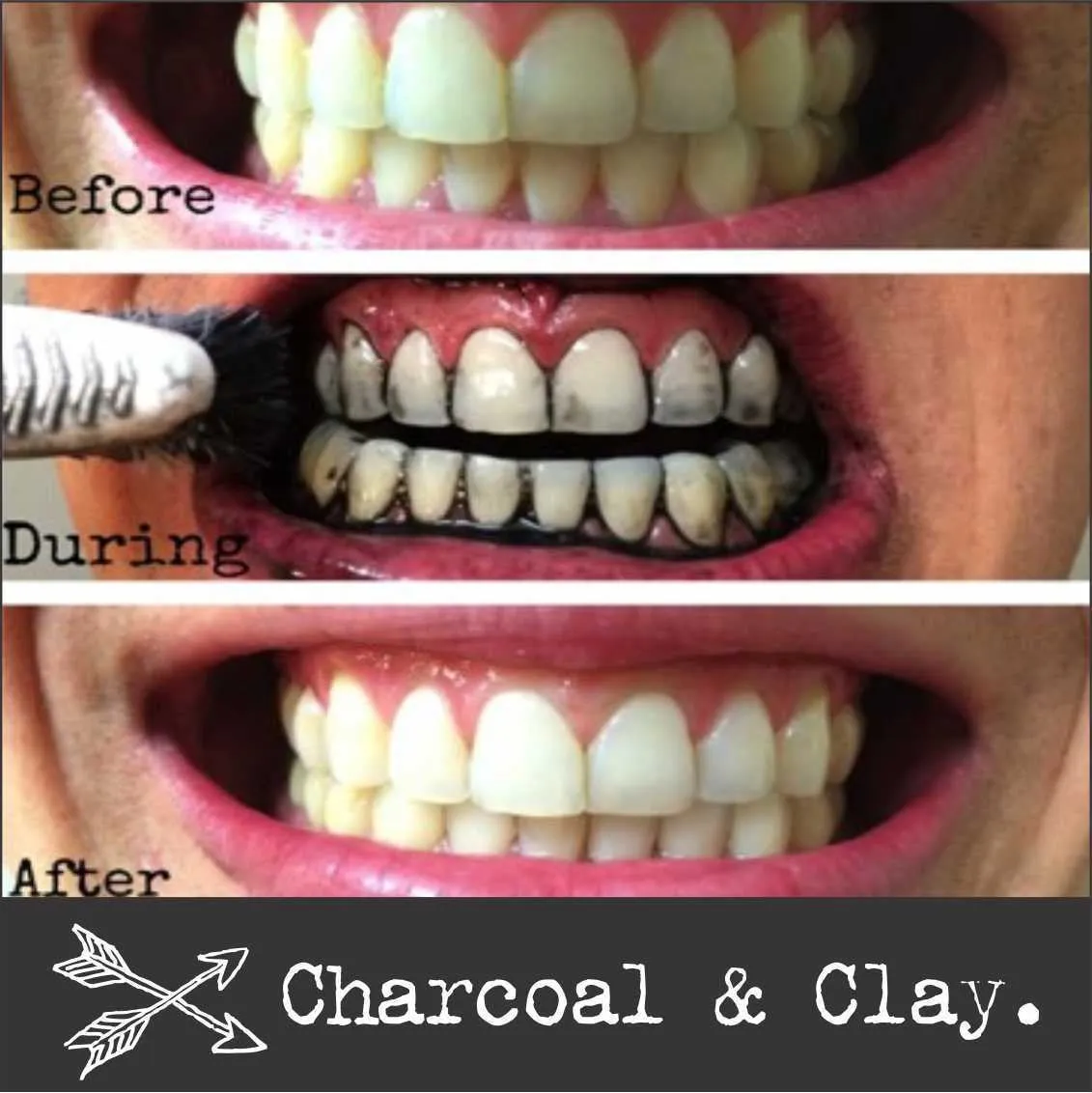 32595 charcoal teeth whitening risks image6