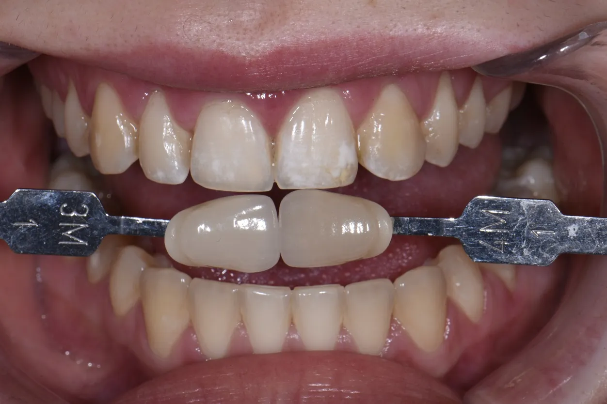 32596 bright smile maintenance