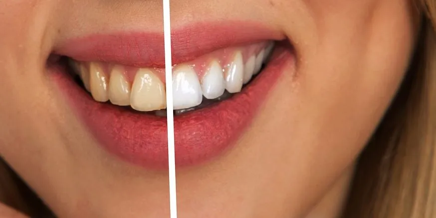 32597 teeth whitening products comparison
