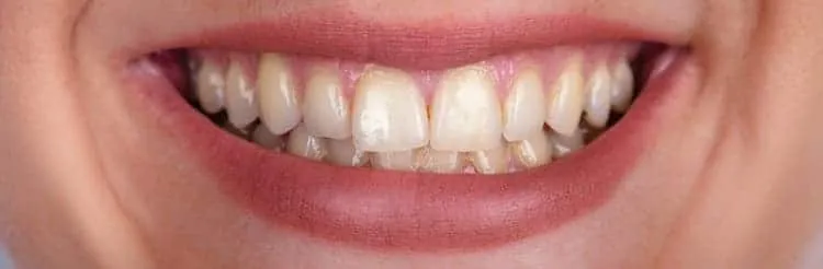 32597 teeth whitening take home kit