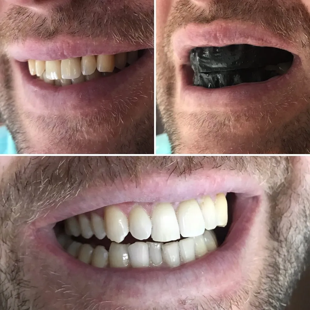 32600 sensitive teeth