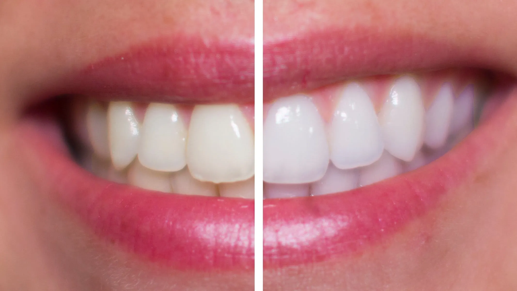 32602 diy teeth whitening methods