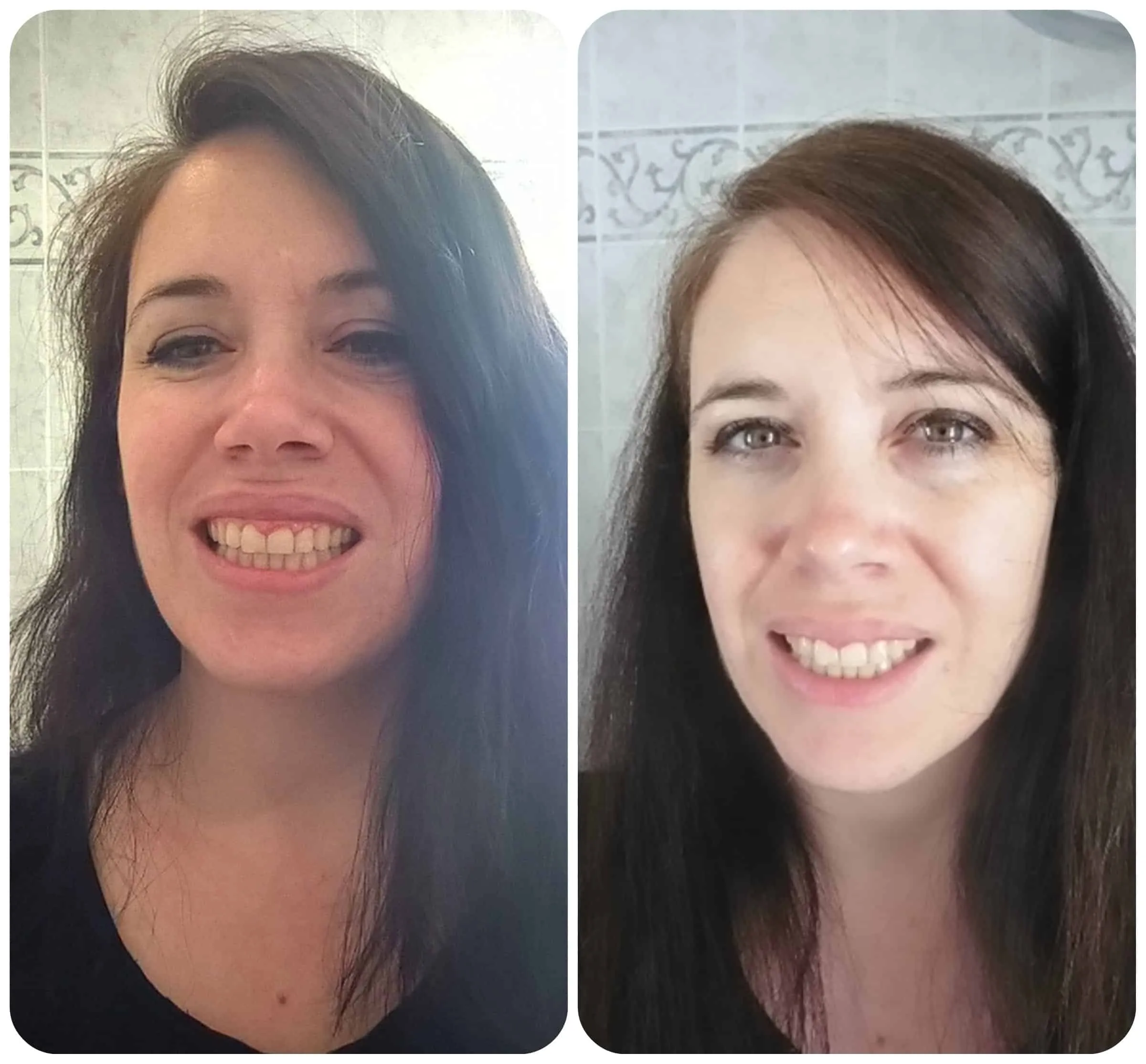 32607 iwhite whitening before after