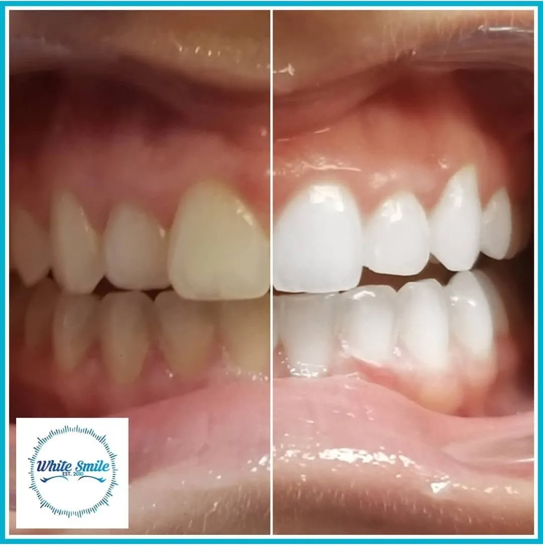 32614 diy teeth whitening