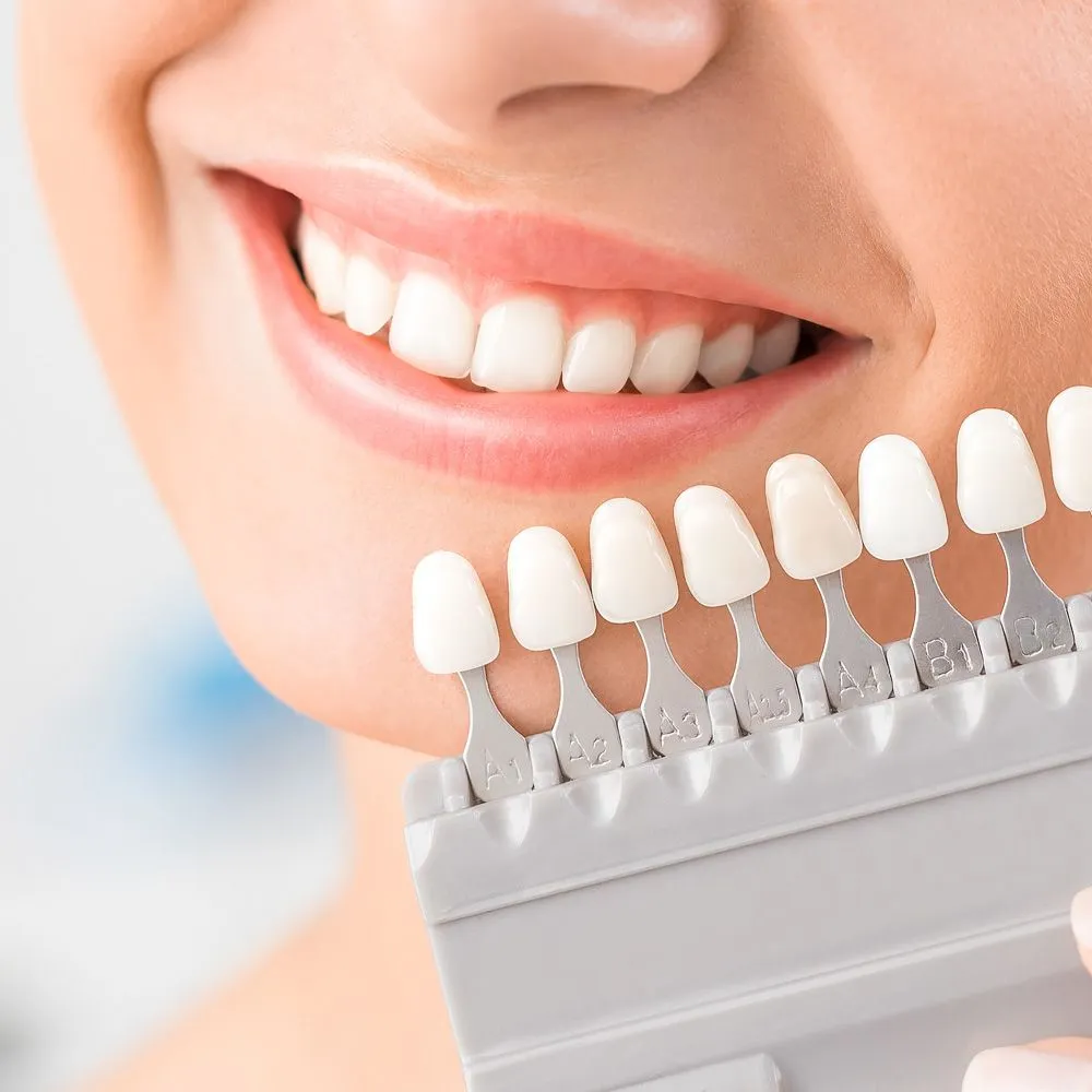 32614 professional teeth whitening