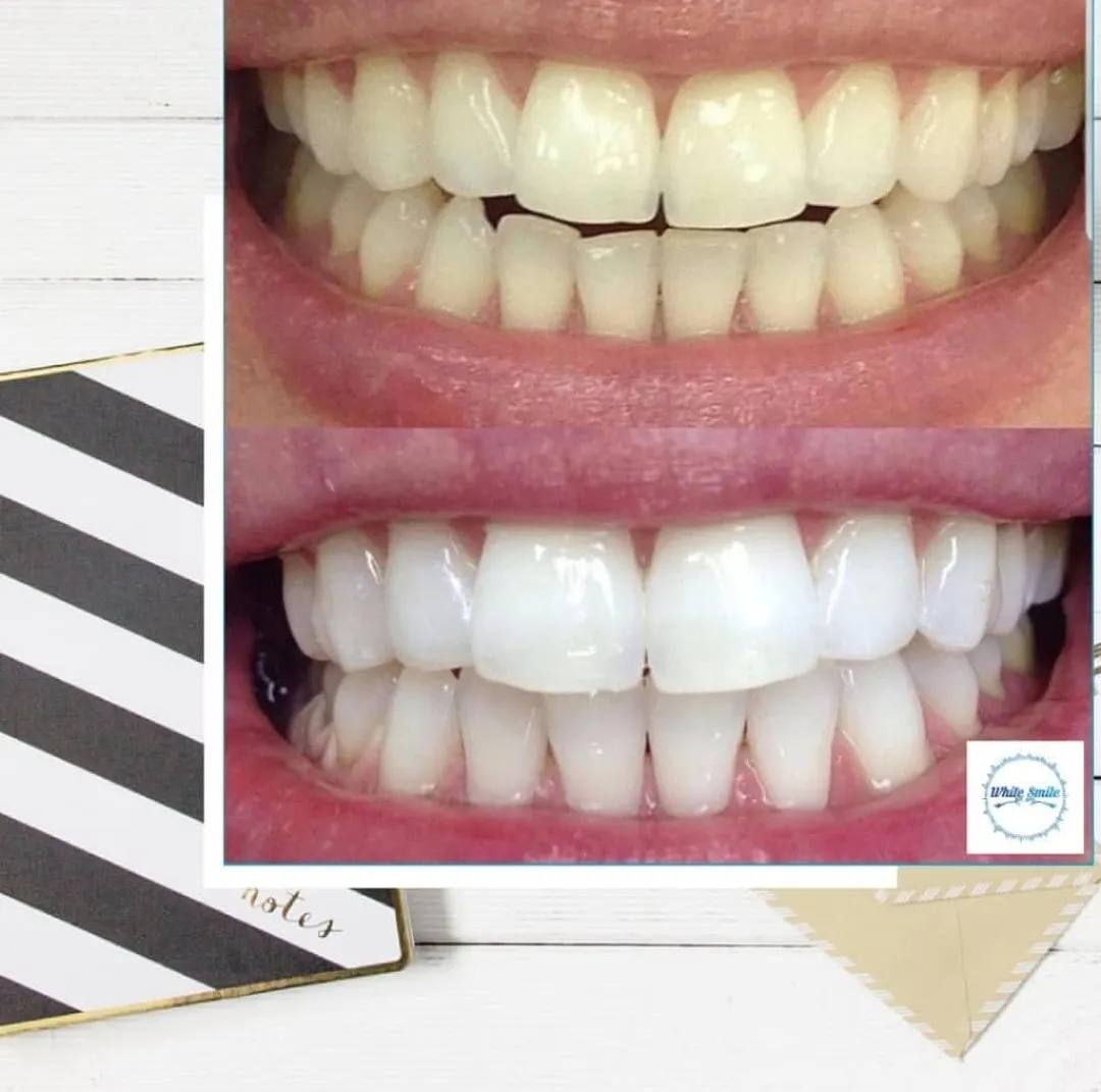 32614 take home whitening kit