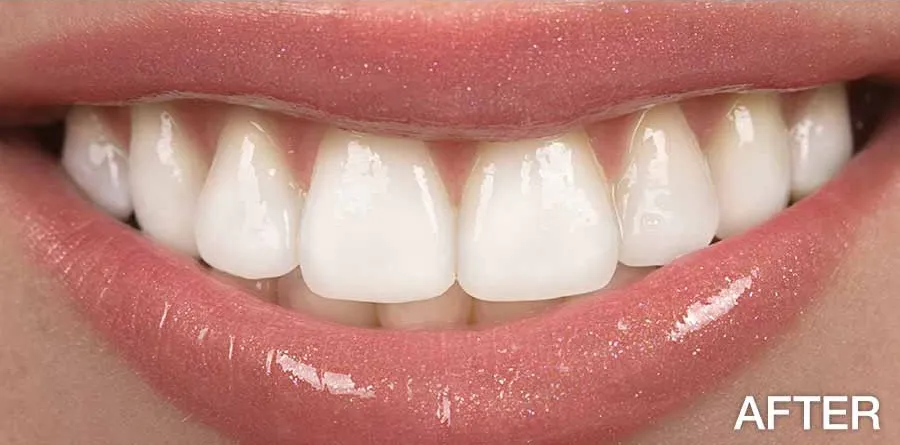 32614 teeth whitening procedure