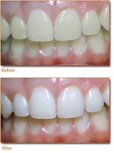 32623 at home teeth whitening