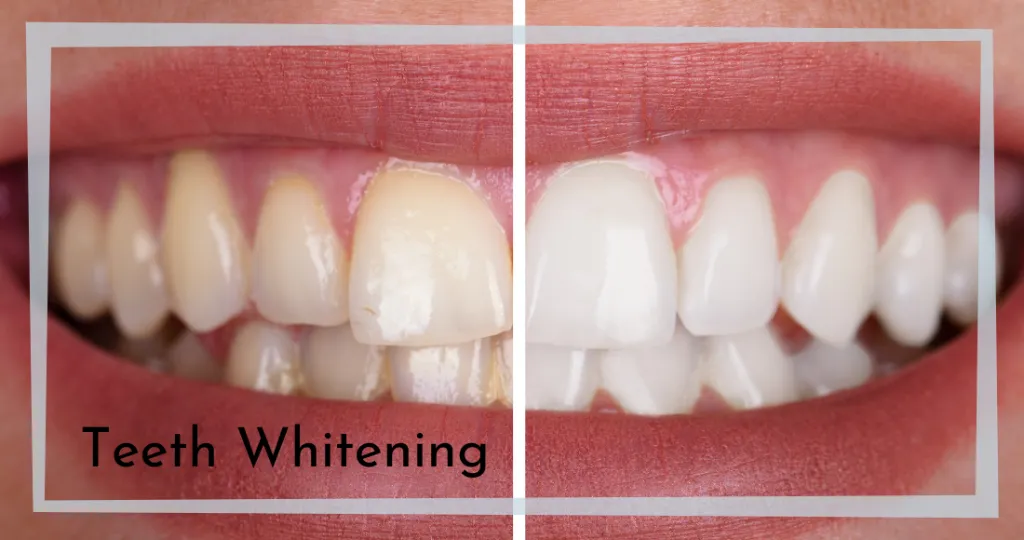 32631 teeth whitening options