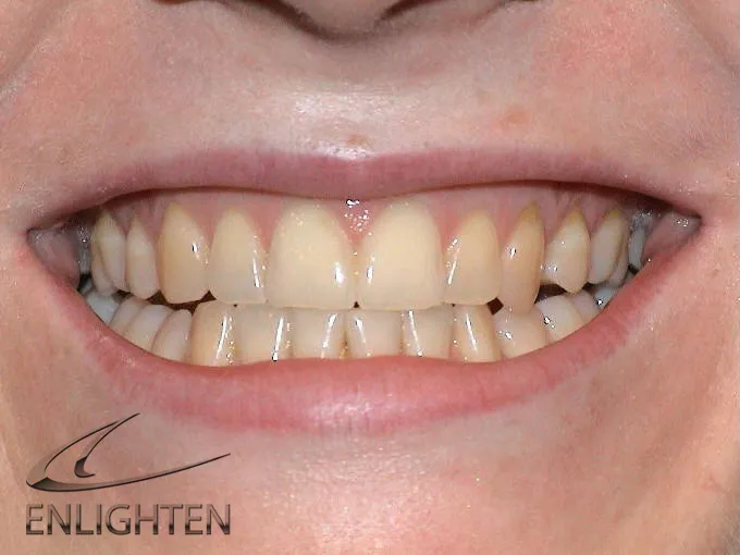 /img/32632-professional-teeth-whitening.webp