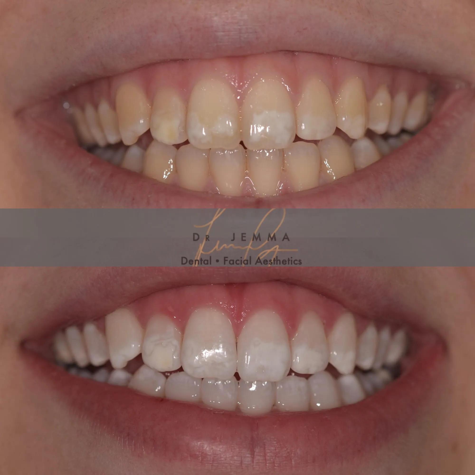 32632 whitening strips