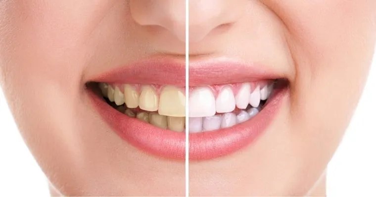 /img/32637-teeth-whitening-options.webp