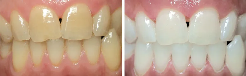 32638 western dental teeth whitening procedure